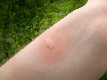 Mosquito Bite Identification